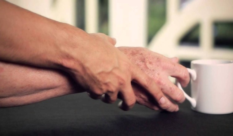 parkinson