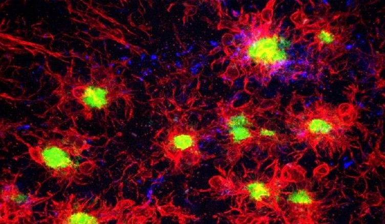 cellula blocca alzheimer
