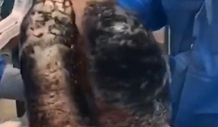 polmoni neri paziente fumatore