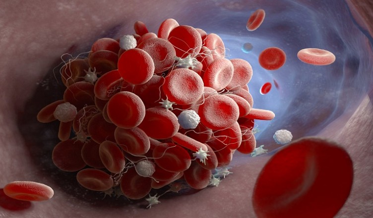 coagulo sangue
