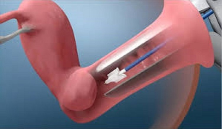pap test ovaio