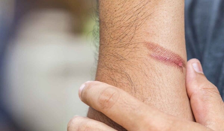 Close up burning skin on arm, Injury from fire