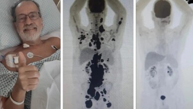 Tumore incurabile, 61enne guarisce in un mese grazie a una terapia sperimentale