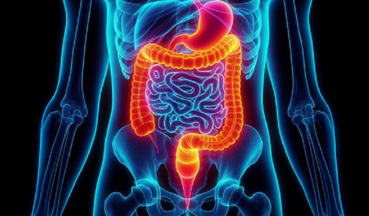 tumore colon